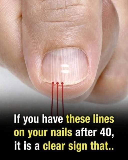 Why Vertical Lines on Your Nails Often Appear With Age Emerson Solomon